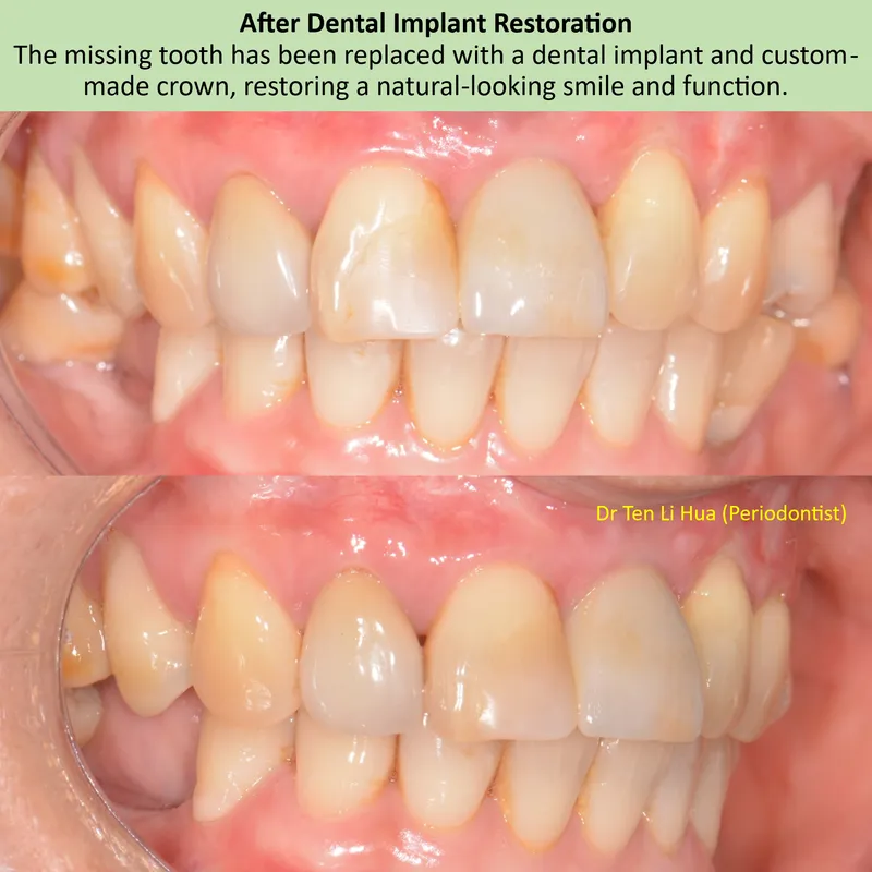 After dental implant restoration — missing tooth replaced with implant and custom crown — JDental Specialists Johor