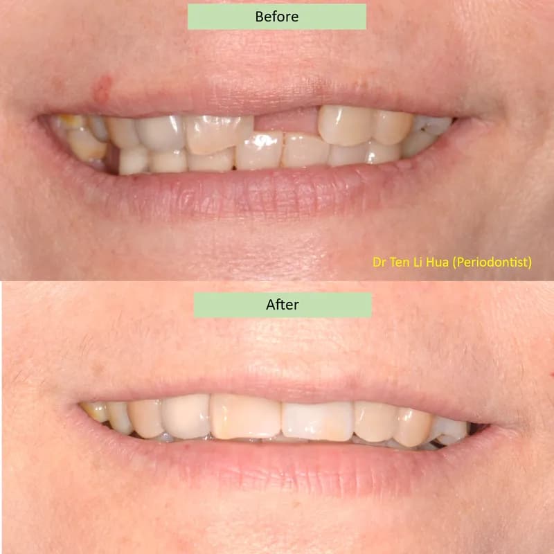 Before and after smile comparison of dental implant treatment — JDental Specialists Johor