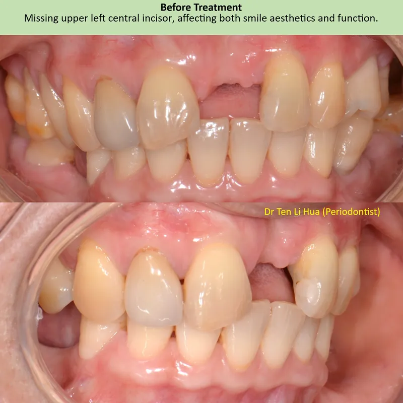 Before treatment — missing upper left central incisor — JDental Specialists Johor