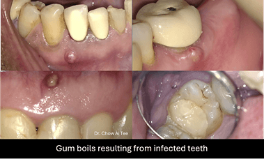 Root canal treatment Johor