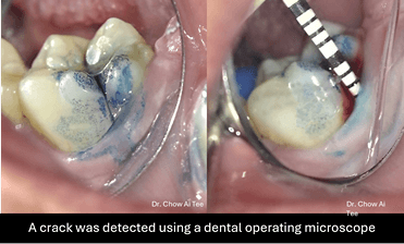 Root canal treatment Johor