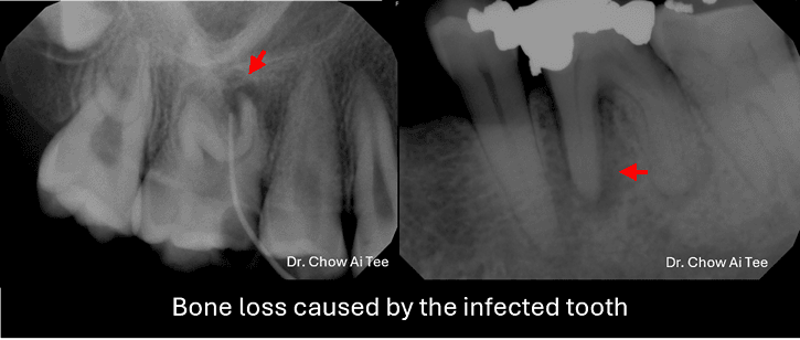 Root canal treatment process Johor