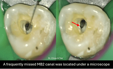 Root canal treatment cleaning Johor
