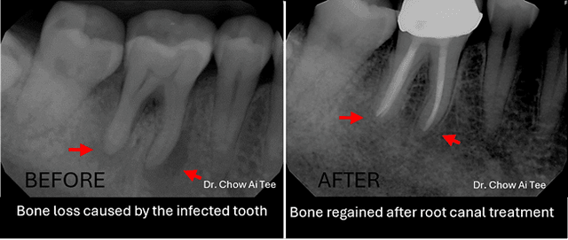 Root canal review Johor