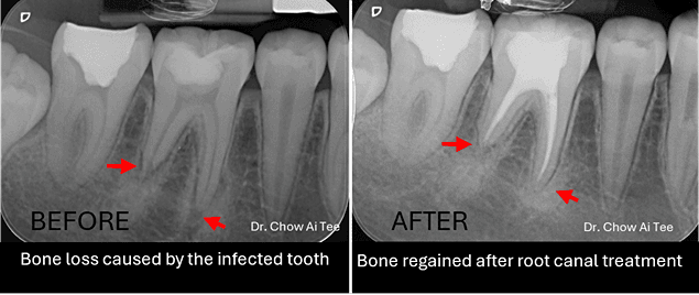 Root canal outcome Johor