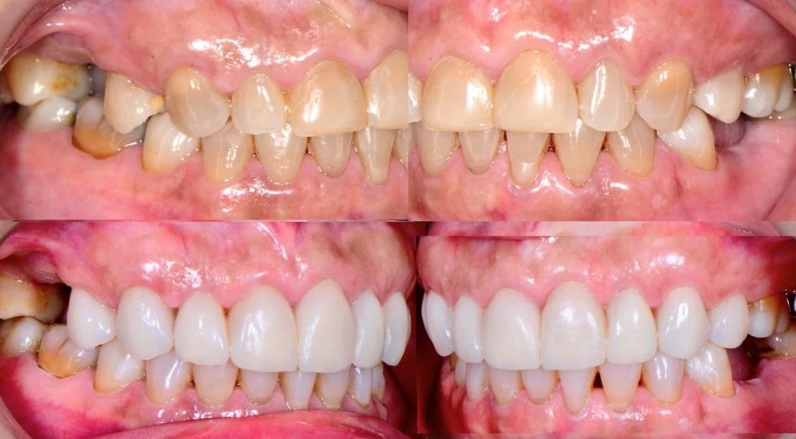 Confident smile after full mouth rehabilitation with veneers and onlays Johor