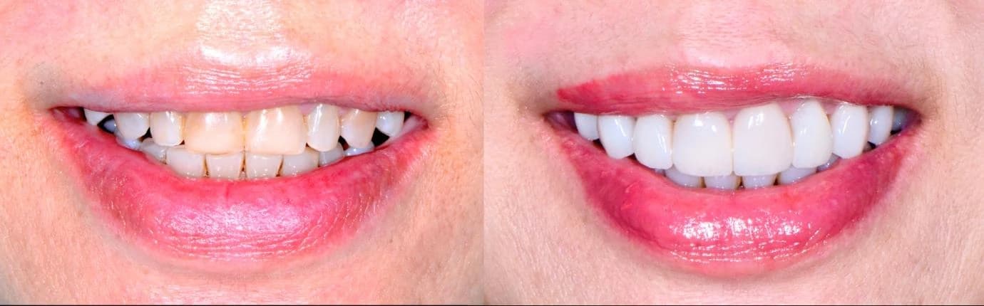 Full mouth rehabilitation before and after with veneers and onlays Johor