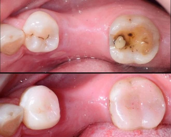 Posterior teeth restored with custom onlays Johor