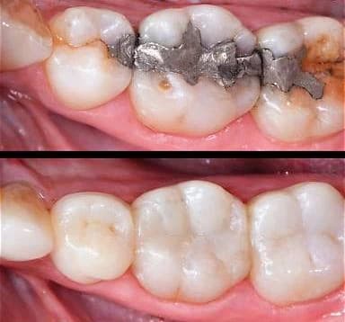 Worn posterior teeth before onlays Johor
