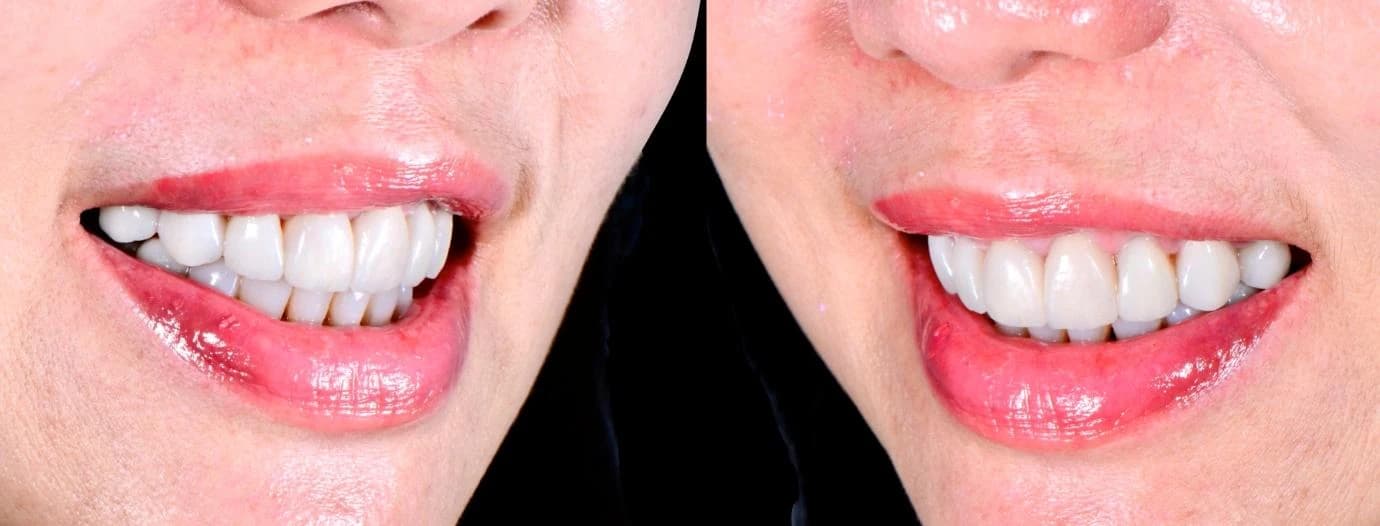 Patient reclaiming life after full mouth rehabilitation Johor