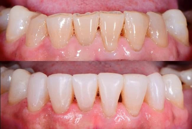 Upper and lower front teeth restored with veneers Johor