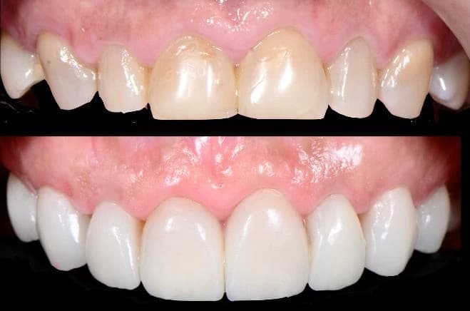 Worn upper and lower front teeth before veneers Johor