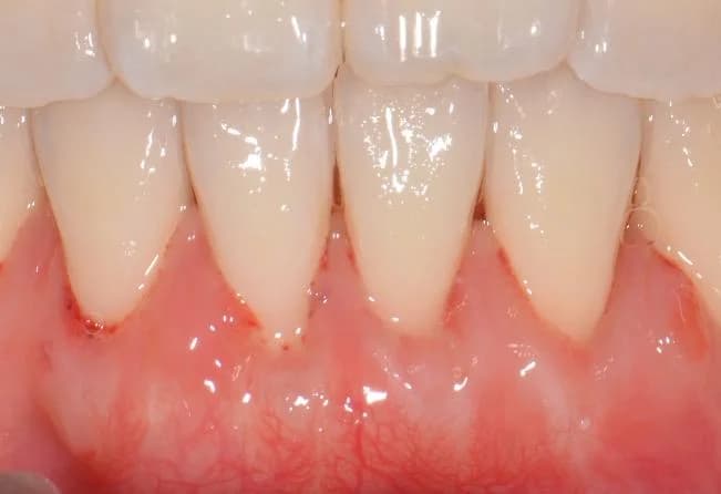After gum graft surgery — improved gum coverage on lower front teeth Johor