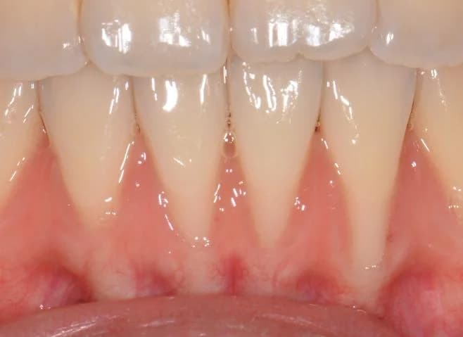 Before gum graft surgery — recession on lower front teeth Johor