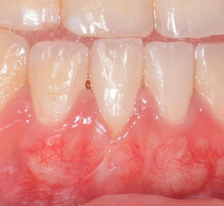 After gum graft surgery — root covered by grafted gum tissue Johor