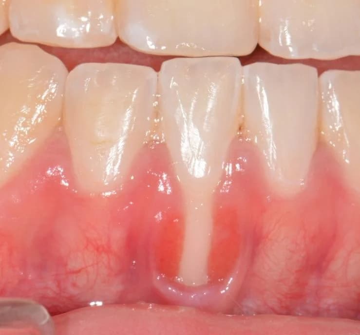 Before gum graft surgery — extensive root exposure on a lower incisor Johor