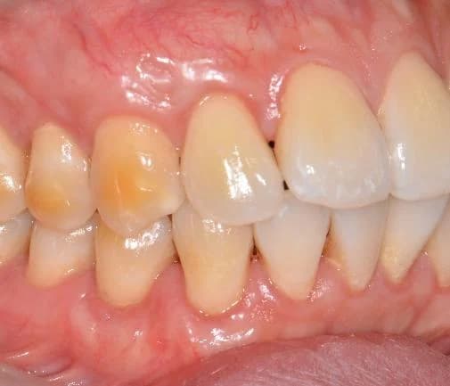 After gum graft surgery — multiple recession sites improved Johor