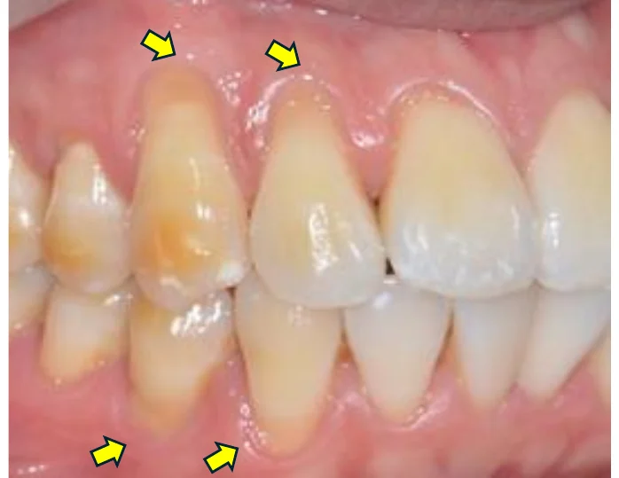 Before gum graft surgery — arrows marking multiple areas of recession Johor