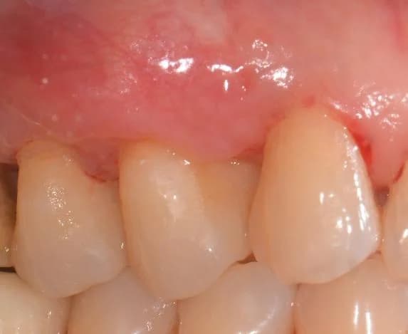 After gum graft surgery — thicker gum around an upper back tooth Johor