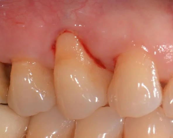 Before gum graft surgery — recession on an upper back tooth Johor