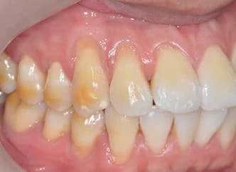 Gum recession from aggressive tooth brushing Johor