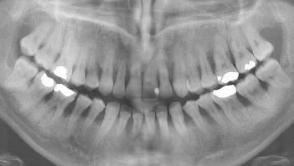 Dental X-ray showing bone loss around teeth Johor