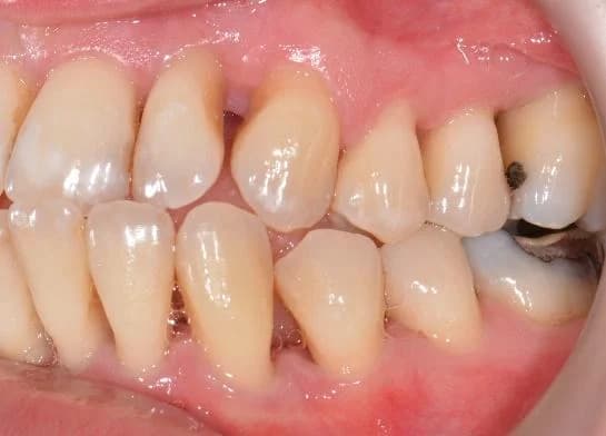 Gum recession caused by periodontal disease Johor