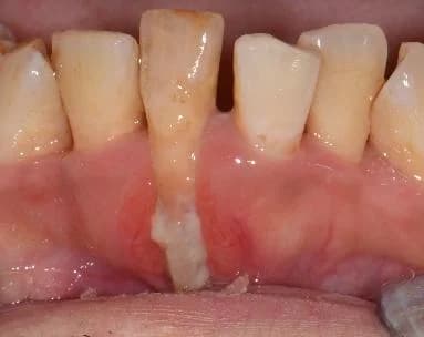 Severe gum recession with extensive root exposure Johor