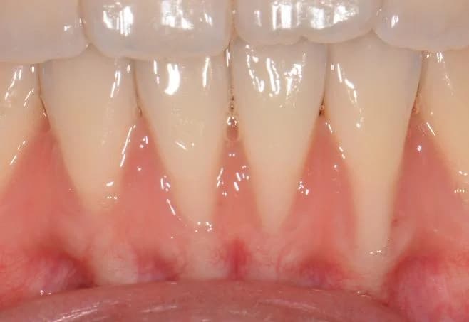 Gum recession from naturally thin gum tissue Johor