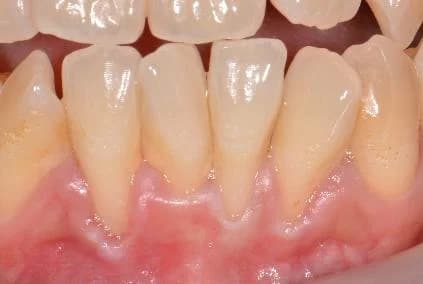 Gum recession from tooth position outside the bone Johor