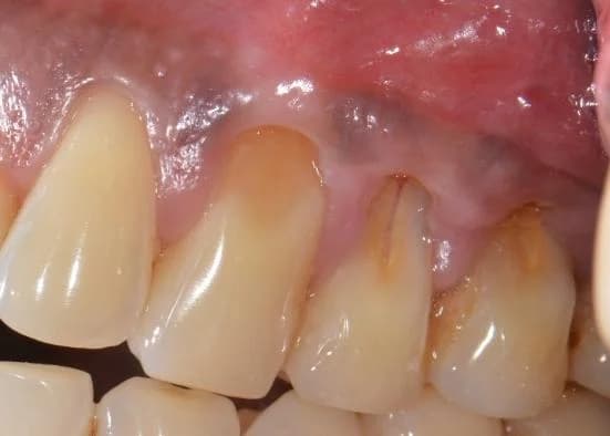 Root wear and sensitivity from untreated gum recession Johor