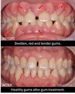 Gum disease periodontitis Johor