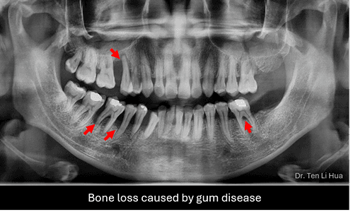 Periodontal assessment Johor