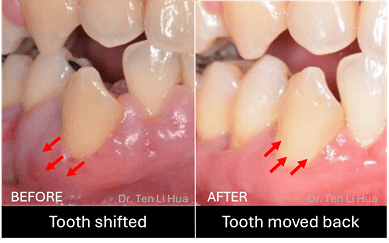 Deep cleaning periodontal Johor