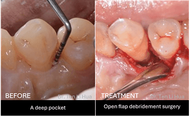 Open flap debridement surgery Johor