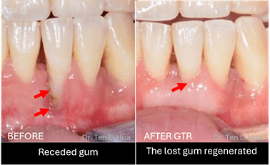 Gum grafting surgery Johor