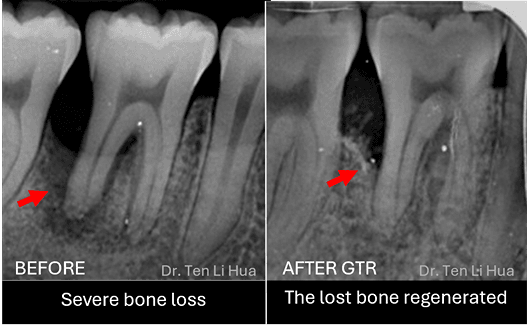 Bone grafting periodontal Johor
