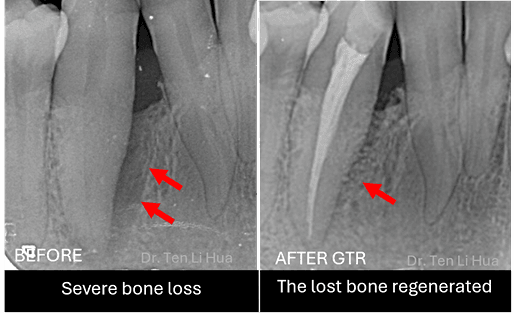 Guided tissue regeneration Johor