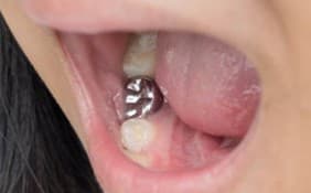 Stainless steel crown on a child's back tooth