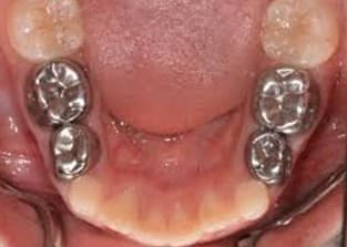 Multiple stainless steel crowns on children's lower teeth