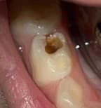 Before: Decayed tooth requiring a stainless steel crown