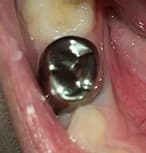 After: Stainless steel crown placed on child's tooth