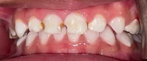 Before: Rampant caries on child's front teeth