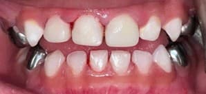 After: Stainless steel crowns placed on child's front teeth