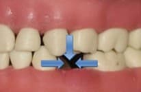 Early loss of baby tooth leading to shifting