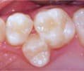 Teeth shifting after early baby tooth loss