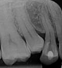 Crowding risk from early tooth loss