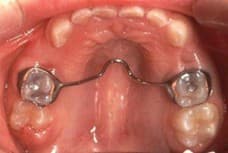 Transpalatal Arch