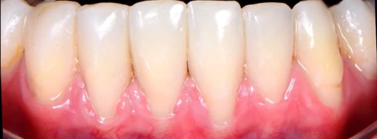Lower front teeth after closing black triangles Johor