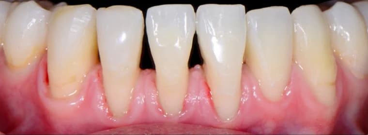 Black triangles between lower front teeth before treatment Johor